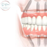 Group logo of All-On-Four Treatment Concept in Dental Implants