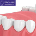 Group logo of Porcelain Veneers vs Composite Veneers: Which Is Better?